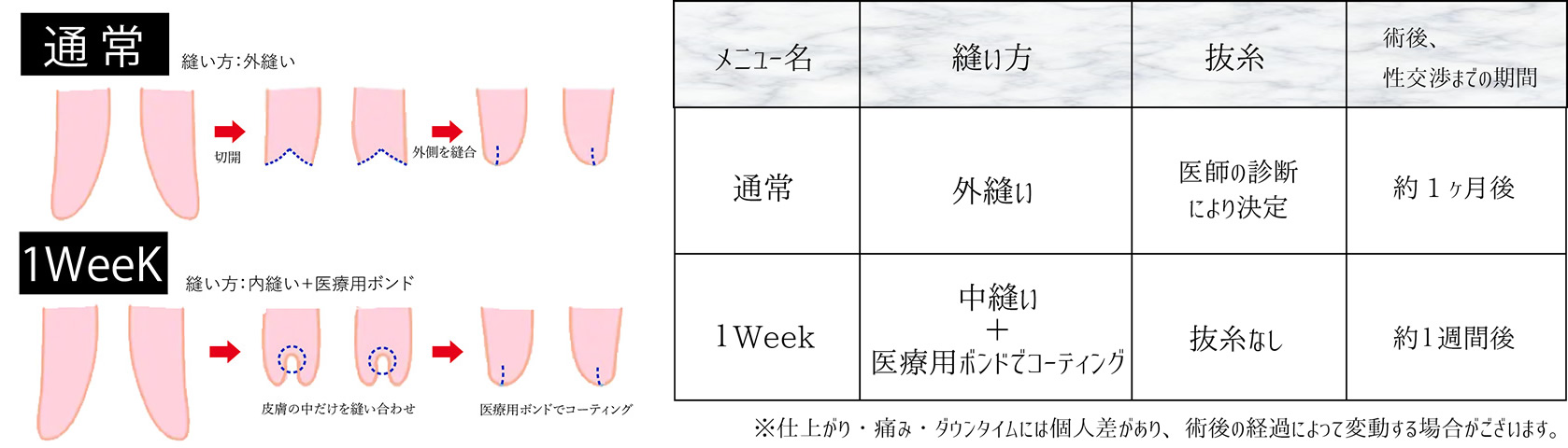 小陰唇縮小1week